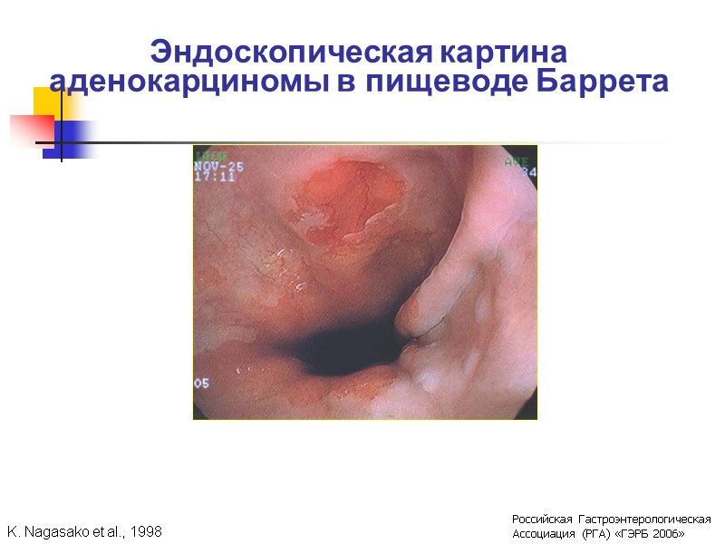 Эндоскопическая картина аденокарциномы в пищеводе Баррета K. Nagasako et al., 1998 Российская Гастроэнтерологическая Ассоциация